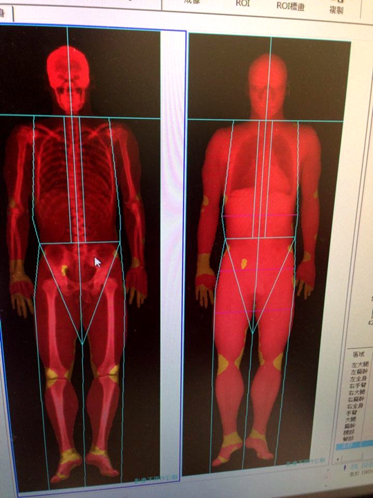 【圖】DEXA(骨密度身體組成)