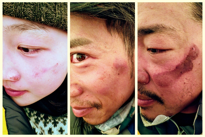 長期帶著防寒面罩,呼吸水氣與空氣接觸,導致隊員們面部留有大小不等的凍傷