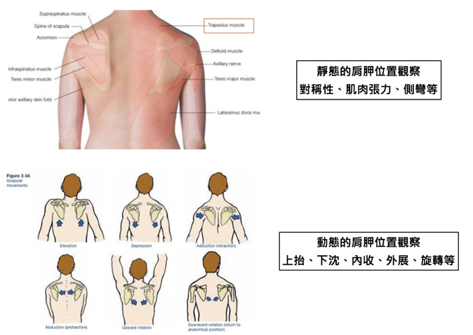 肩關節滑液囊發炎容易導致棘上肌肌腱損傷。(圖片來源:康鈞尉醫師)