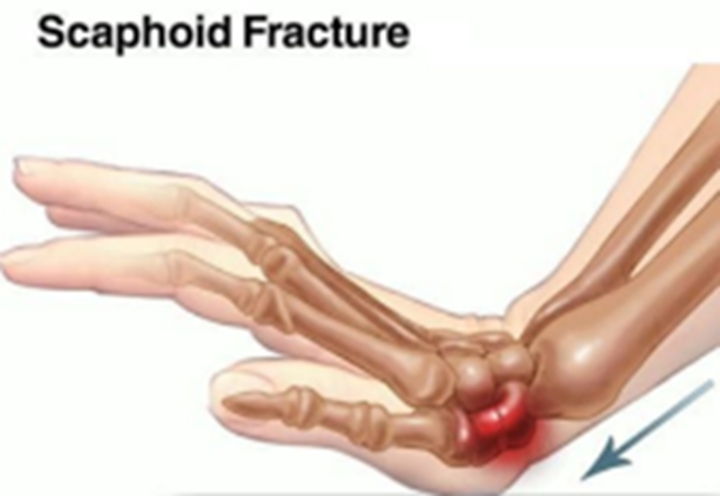FOOSH(Fall On Out-Stretched Hand)